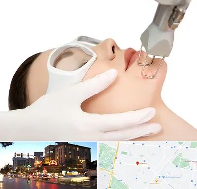 لیزر فرکشنال در بلوار سجاد مشهد 