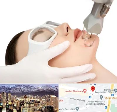 لیزر فرکشنال در جردن 