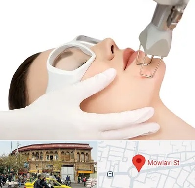 لیزر فرکشنال در مولوی