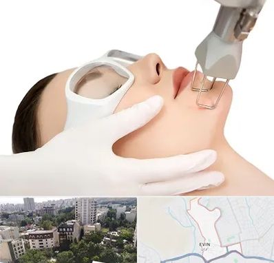 لیزر فرکشنال در اوین