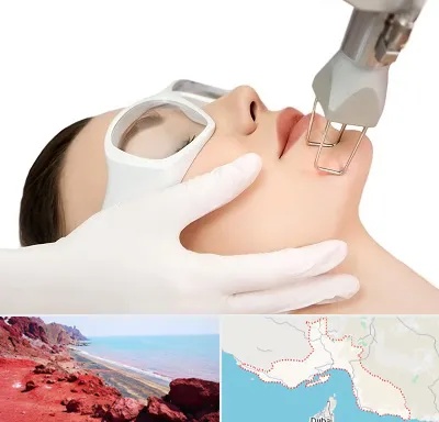 لیزر فرکشنال در هرمزگان