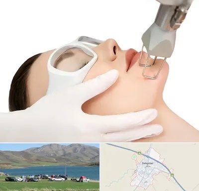 لیزر فرکشنال در دهگلان