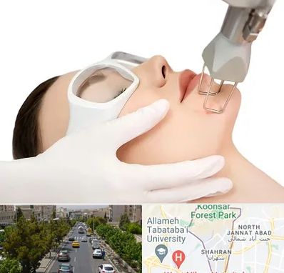 لیزر فرکشنال در شهران 