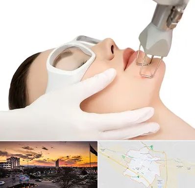 لیزر فرکشنال در قوچان