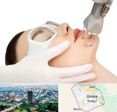 لیزر فرکشنال در ارومیه