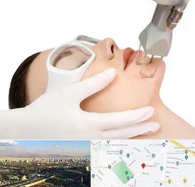 لیزر فرکشنال در هنگام 