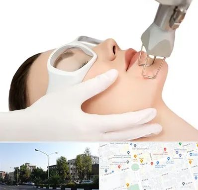 لیزر فرکشنال در میدان کاج 