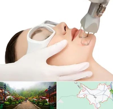 لیزر فرکشنال در فومن