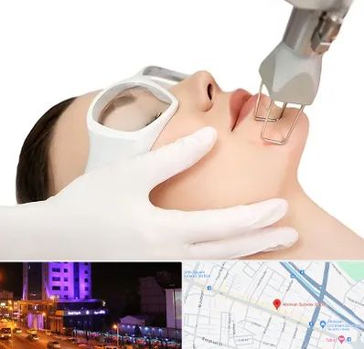 لیزر فرکشنال در آبرسان تبریز