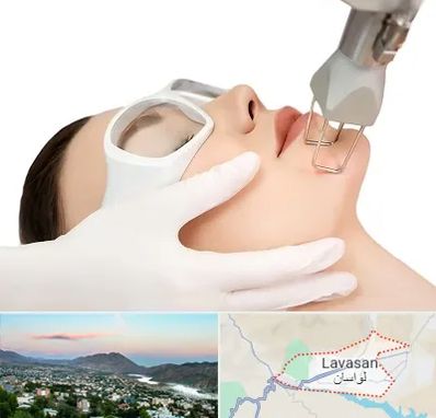 لیزر فرکشنال در لواسان