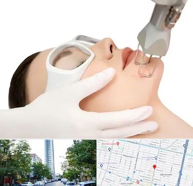 لیزر فرکشنال در امامت مشهد