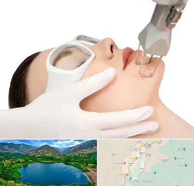 لیزر فرکشنال در رودبار