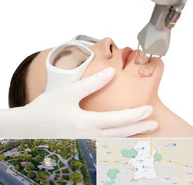 لیزر فرکشنال در کاشمر