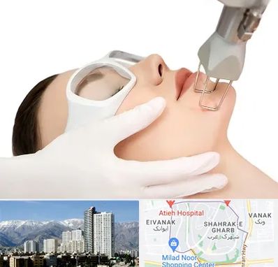 لیزر فرکشنال در شهرک غرب 