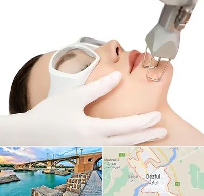 لیزر فرکشنال در دزفول