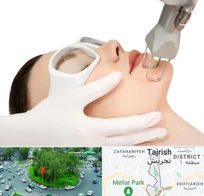 لیزر فرکشنال در تجریش 