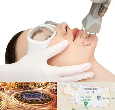 لیزر فرکشنال در بهارستان