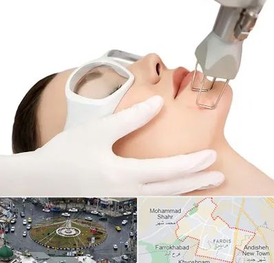 لیزر فرکشنال در فردیس کرج 