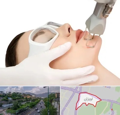 لیزر فرکشنال در لویزان