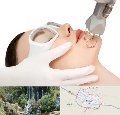 لیزر فرکشنال در شیروان