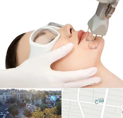 لیزر فرکشنال در فلاح