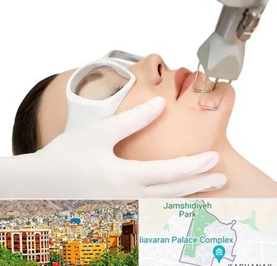 لیزر فرکشنال در نیاوران 