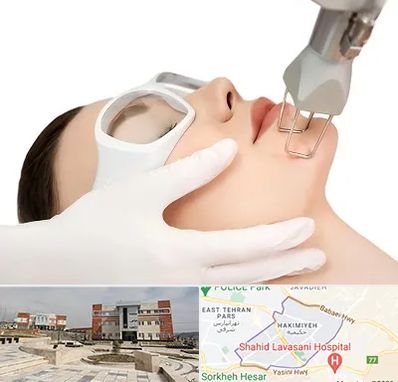 لیزر فرکشنال در حکیمیه 