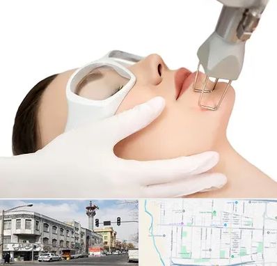 لیزر فرکشنال در 17شهریور