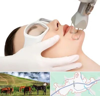 لیزر فرکشنال در تالش