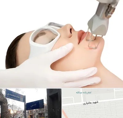 لیزر فرکشنال در سی متری جی
