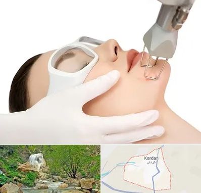 لیزر فرکشنال در کردان