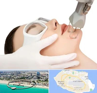 لیزر فرکشنال در کیش