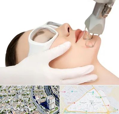 لیزر فرکشنال در قاسم آباد مشهد 