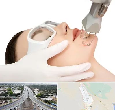 لیزر فرکشنال در اندیمشک