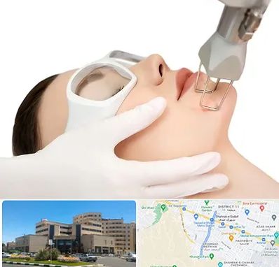 لیزر فرکشنال در صیاد شیرازی مشهد