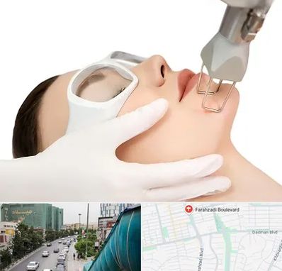 لیزر فرکشنال در بلوار فرحزادی