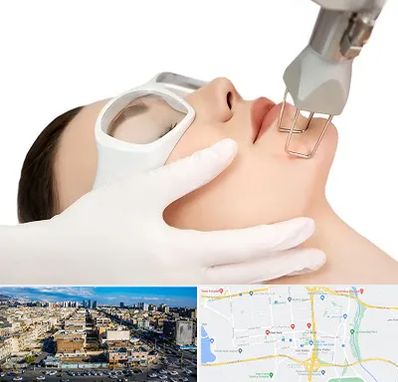 لیزر فرکشنال در شهرک راه آهن