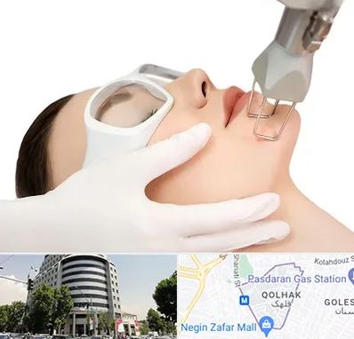 لیزر فرکشنال در قلهک 