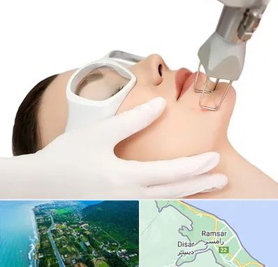 لیزر فرکشنال در رامسر