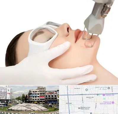 لیزر فرکشنال در مرکز تهران