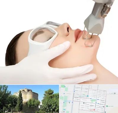 لیزر فرکشنال در مرداویج اصفهان