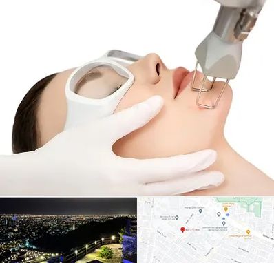 لیزر فرکشنال در هفت تیر مشهد 