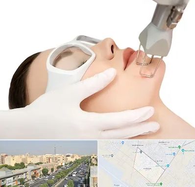 لیزر فرکشنال در کیانمهر کرج