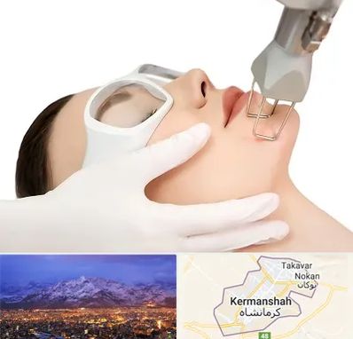 لیزر فرکشنال در کرمانشاه