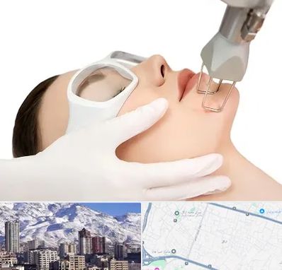 لیزر فرکشنال در ازگل