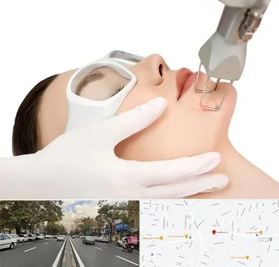 لیزر فرکشنال در دولت 