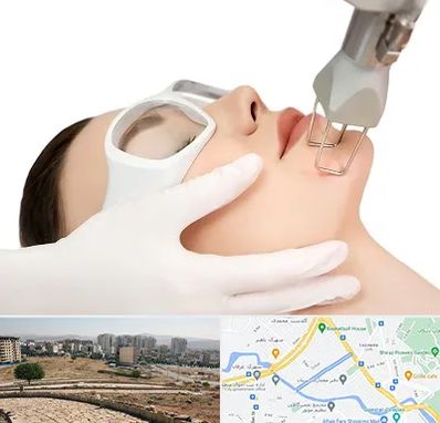 لیزر فرکشنال در کوی وحدت شیراز