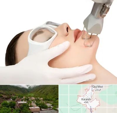لیزر فرکشنال در کلاله