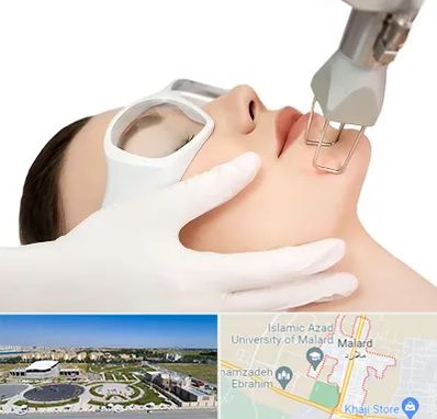 لیزر فرکشنال در ملارد