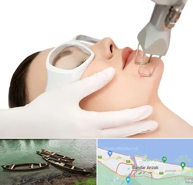 لیزر فرکشنال در بندر انزلی